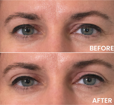 Instantly Lift Your Eyelids for a Youthful Look